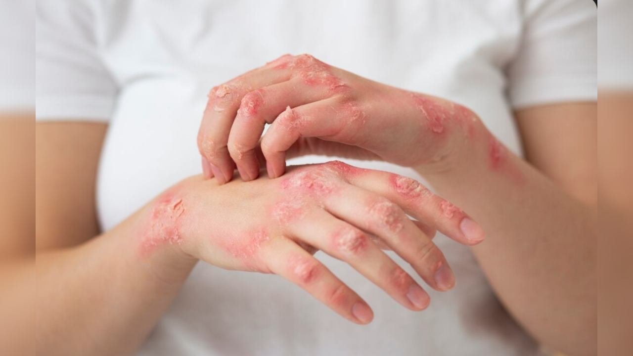 Skin – Many people stay outdoors for long periods during a solar eclipse. This increases exposure to ultraviolet (UV) rays, which can cause: Sunburn, Skin redness, Increased long-term risk of skin damage.